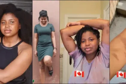 Nigerian lady who hoped for glowing skin battles allergy after relocating to Canada (Video)