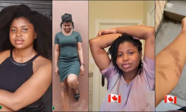 Nigerian lady who hoped for glowing skin battles allergy after relocating to Canada (Video)