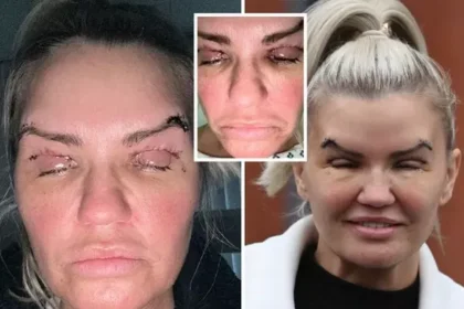 Kerry Katona struggles to open eye after painful eye-lift surgery