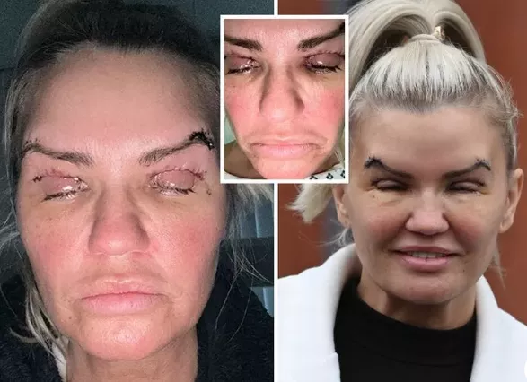 Kerry Katona struggles to open eye after painful eye-lift surgery