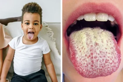 White Tongue: Symptoms, Causes, and Home Remedies for Treatment