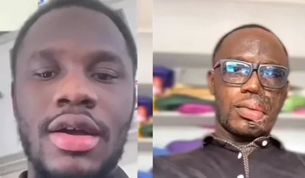 Ghanaian man gets burnt with acid by lover of his ex-girlfriend